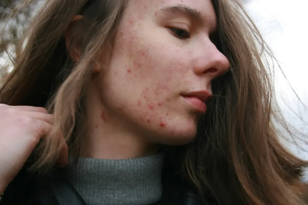 Imagem representa acne da mulher adulta.